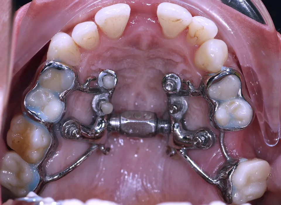 Tooth- and bone-borne expander in place