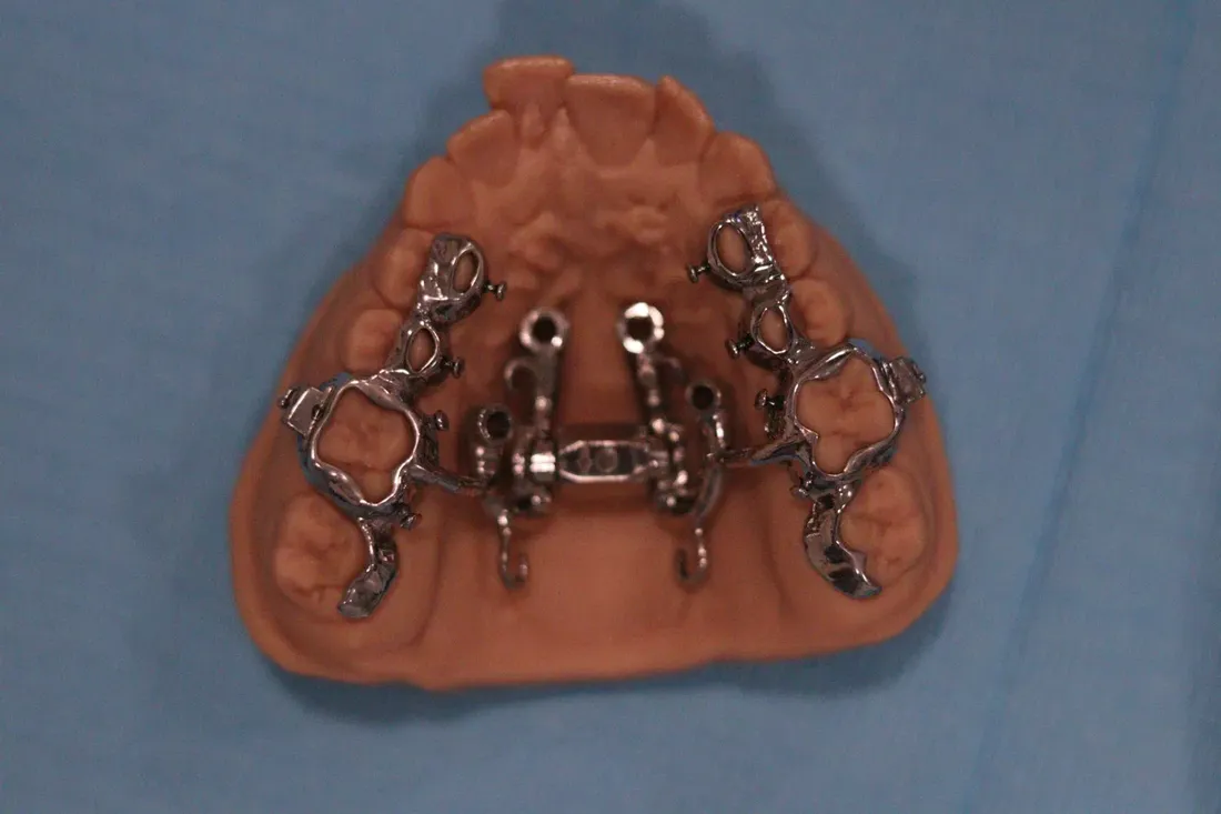 MARPE appliance — palatal view