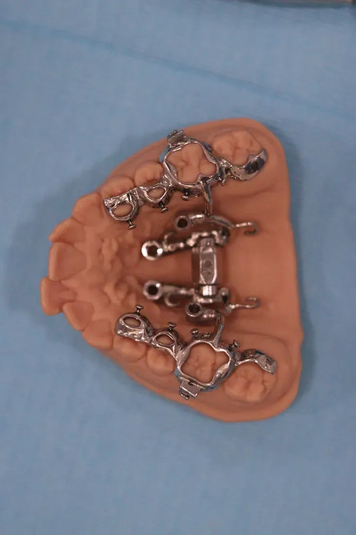 MARPE design with miniscrew housings