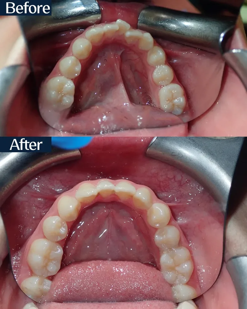 MARPE case 1 — before and after