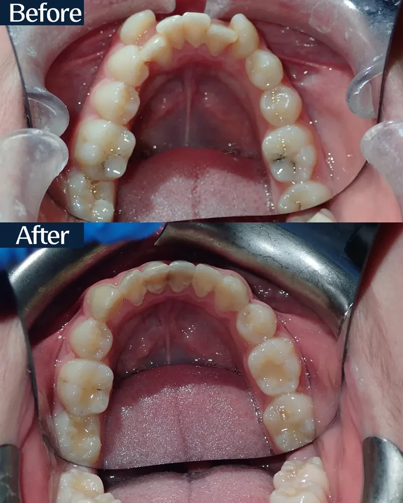 MARPE case 2 — before and after