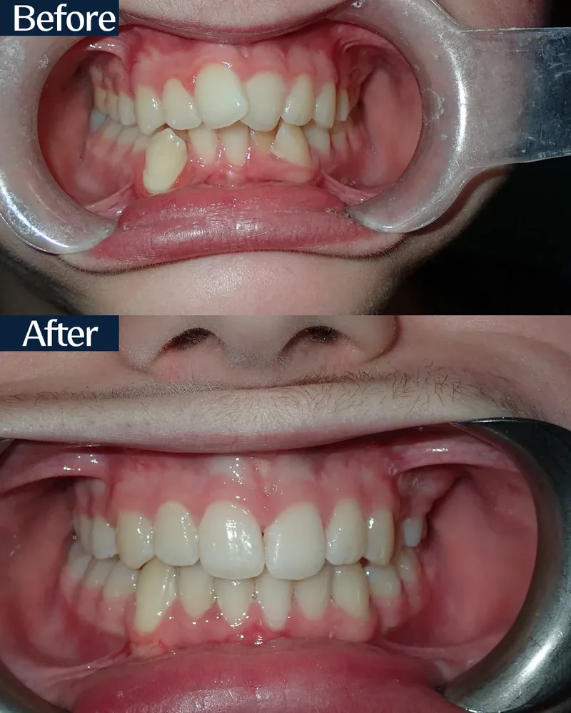 MARPE case 3 — before and after