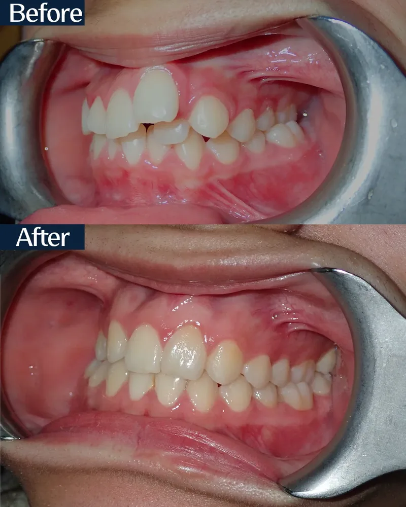 MARPE case 4 — before and after