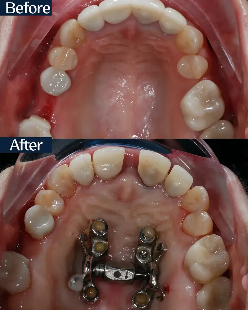 MARPE case 5 — before and after