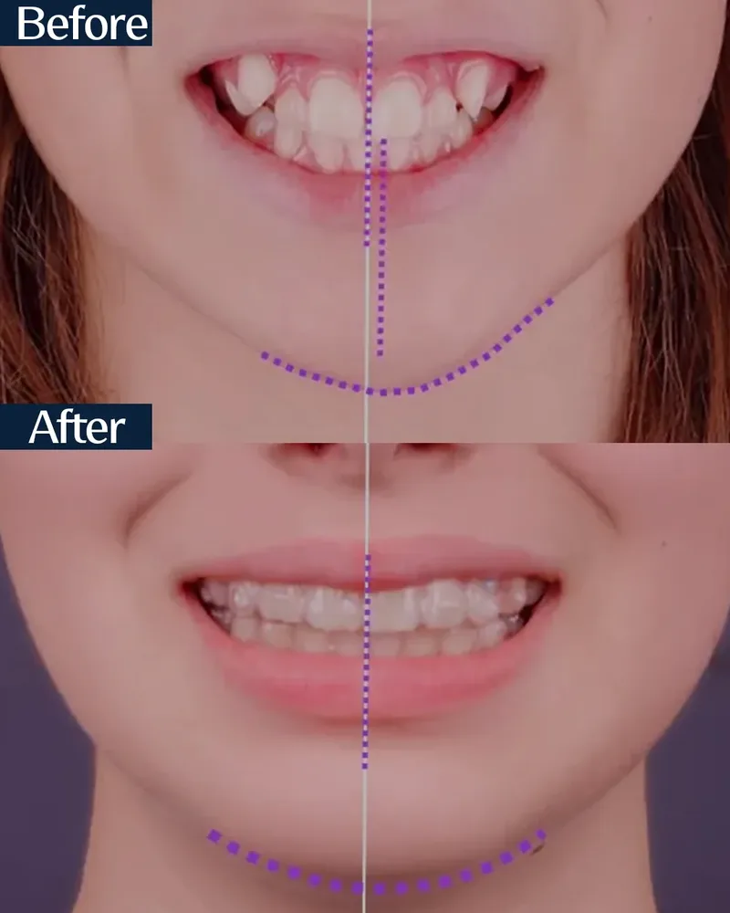 MARPE case 6 — before and after