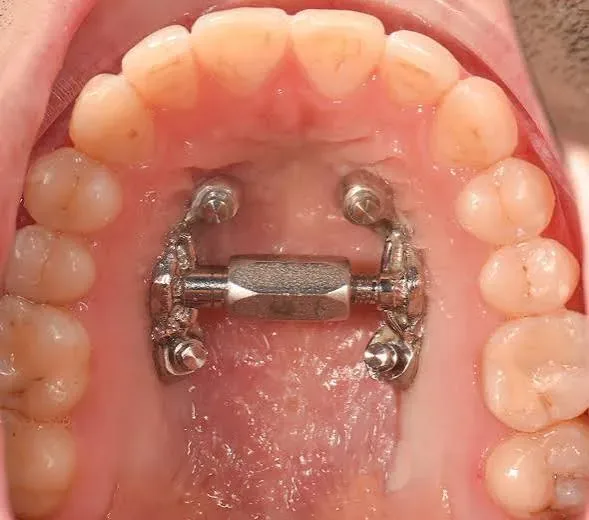 MARPE expander anchored with miniscrews