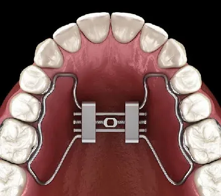 Maxillary expander — 3D illustration