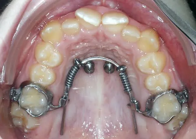 جهاز Beneslider لتحريك الأضراس بتثبيت الغرسات الدقيقة