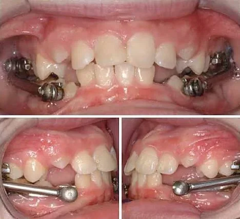 Herbst appliance for lower-jaw growth