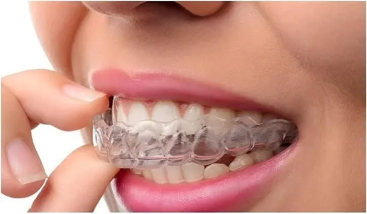 Fitting a clear aligner