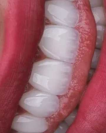Veneer smile detail