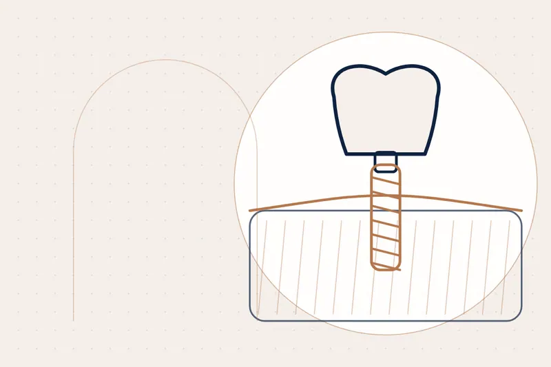 Dental implant or bridge? How to choose