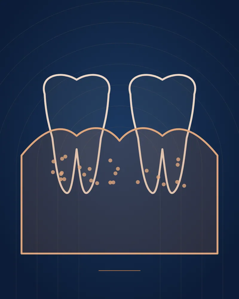 Bleeding Gums — educational illustration