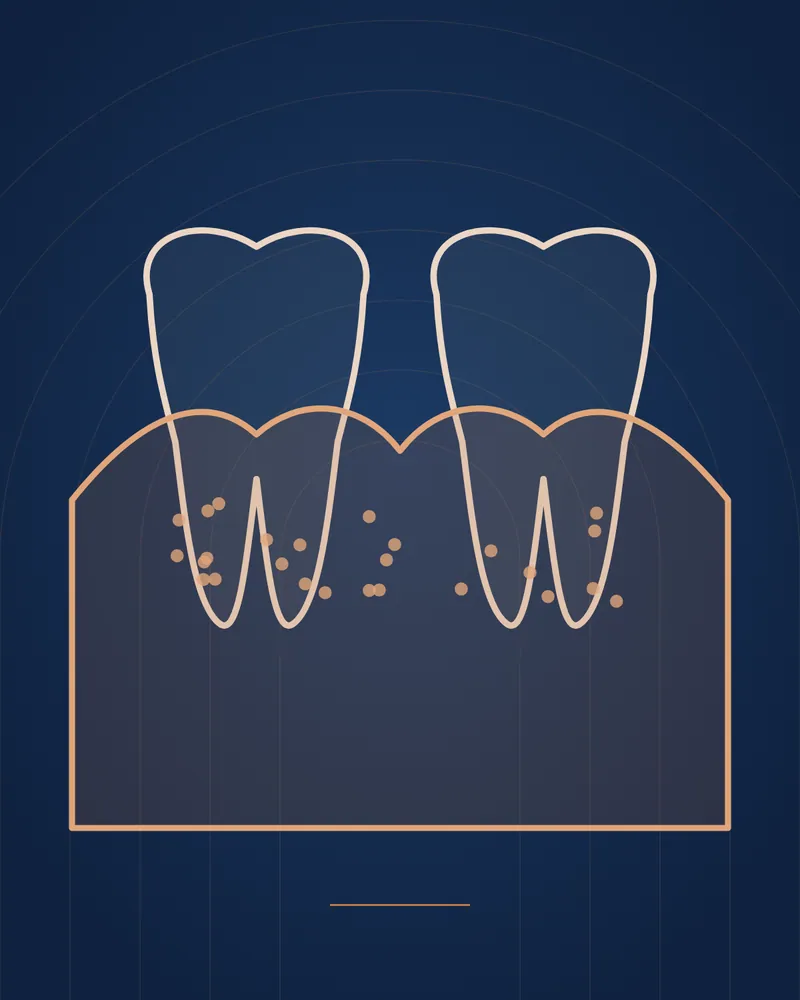 Gum Recession — educational illustration