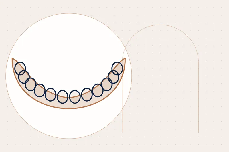 Missing Teeth: causes and treatment — illustration