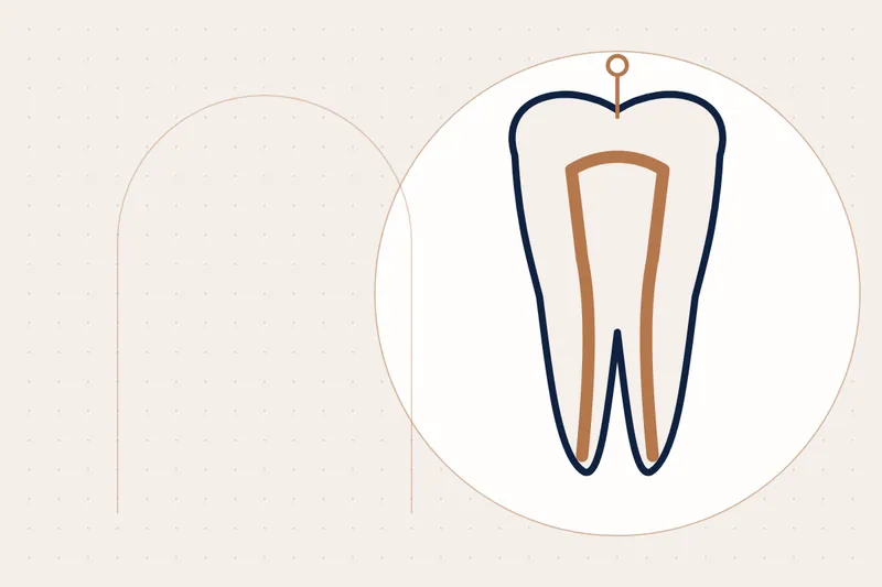 Crowns & Bridges explained — educational illustration