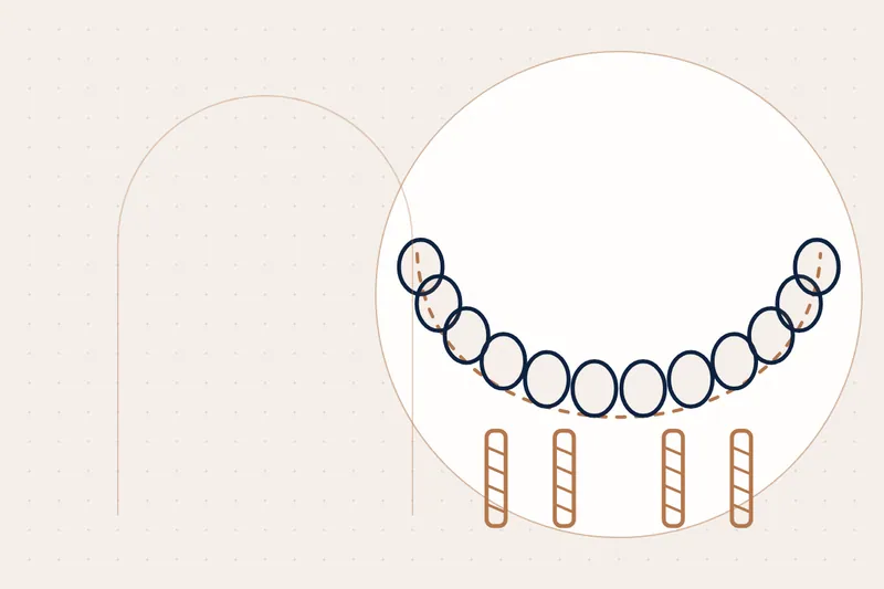 Guided Implant Surgery explained — educational illustration