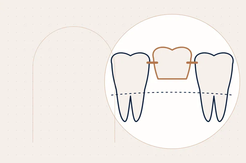 Inlays & Onlays explained — educational illustration