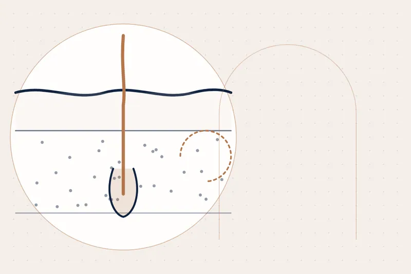 Laser Hair Removal explained — educational illustration