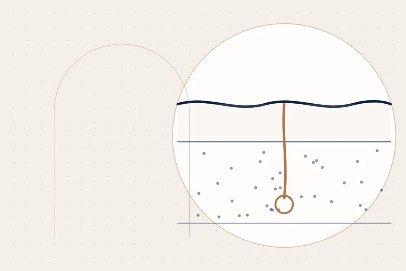 Mesotherapy explained — educational illustration