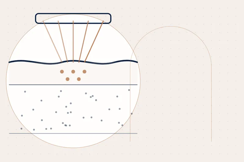 Pigmentation & Melasma Treatment explained — educational illustration