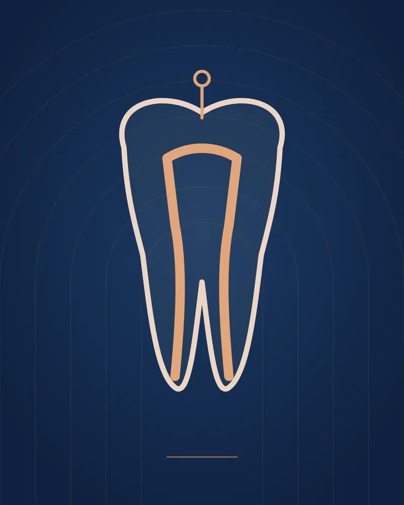 Root Canal Treatment — illustration, Manhal Medical Center Dubai
