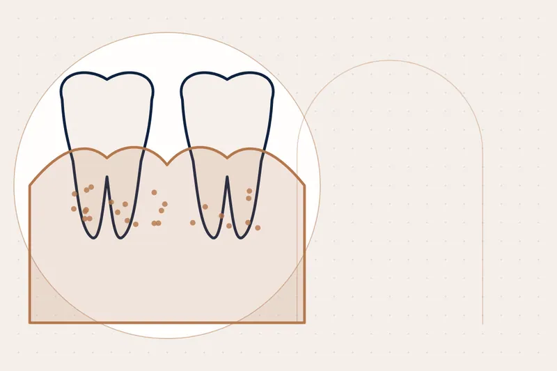 Sensitive Teeth Treatment explained — educational illustration