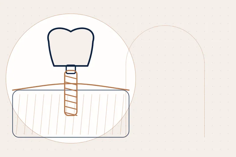 TADs — Orthodontic Mini-Implants explained — educational illustration