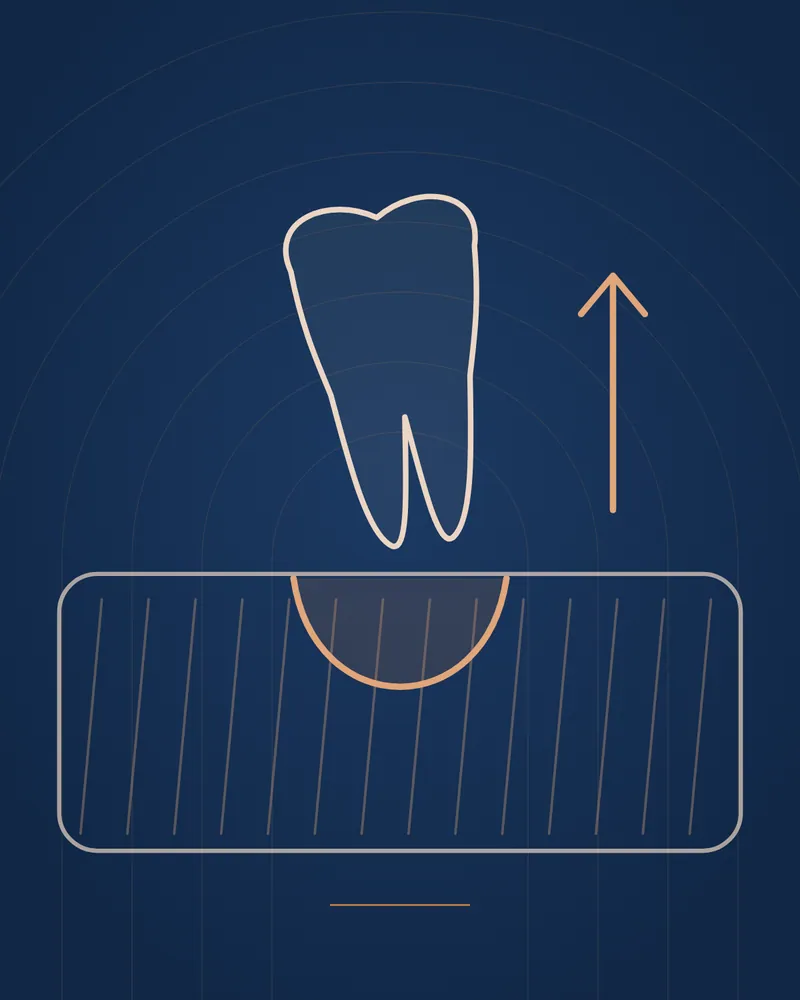 Tooth Extraction — illustration, Manhal Medical Center Dubai