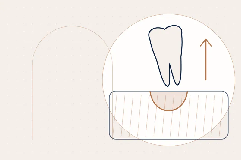 Wisdom Tooth Removal explained — educational illustration