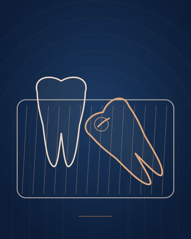 Wisdom Tooth Removal — illustration, Manhal Medical Center Dubai