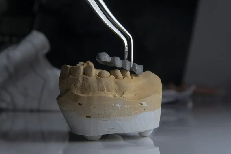 Dental implant cost in Dubai — Manhal Medical Center, Dubai