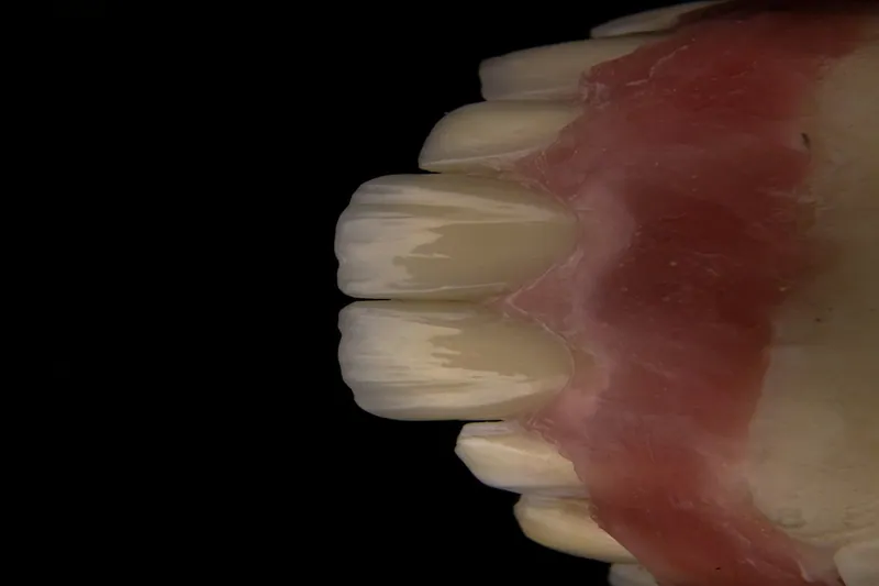 Dental implant risks and disadvantages — Manhal Medical Center, Dubai