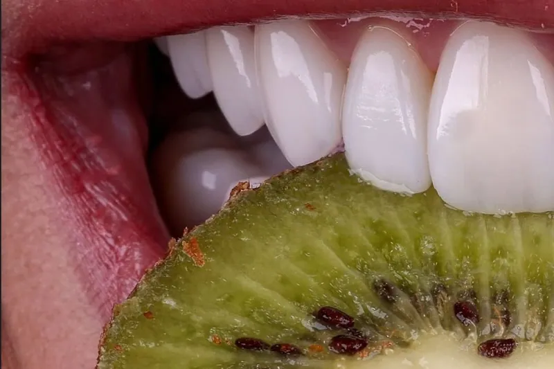 Hollywood smile vs veneers — Manhal Medical Center, Dubai