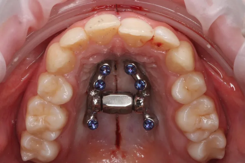 MARPE recovery: what to expect from fitting day to the end of expansion — Manhal Medical Center, Dubai