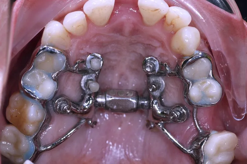 MSE vs MARPE: clarifying the terms and how the orthodontist chooses a design — Manhal Medical Center, Dubai