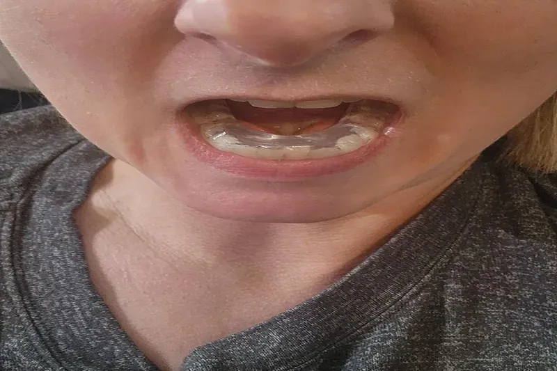 Braces with missing teeth — Manhal Medical Center, Dubai
