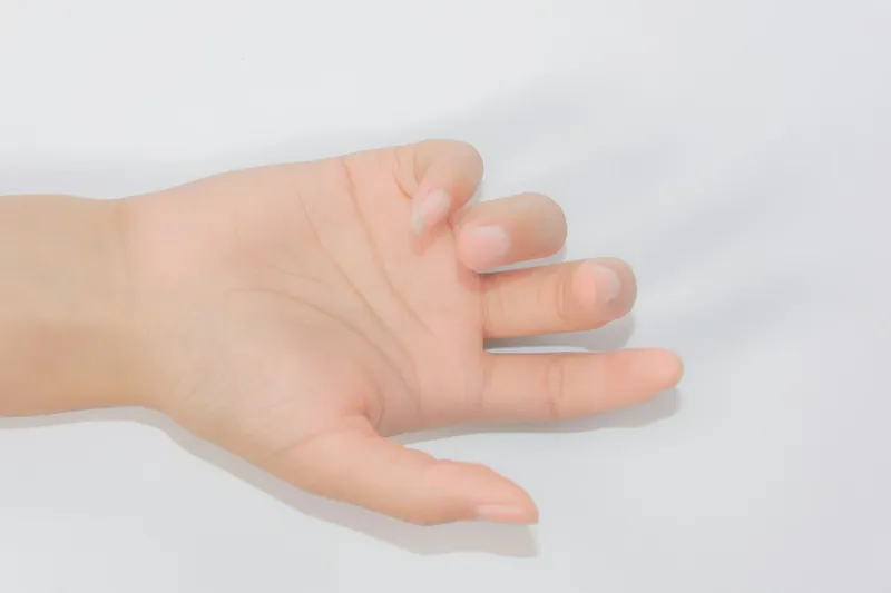 Scalp psoriasis treatment in Dubai — Manhal Medical Center, Dubai