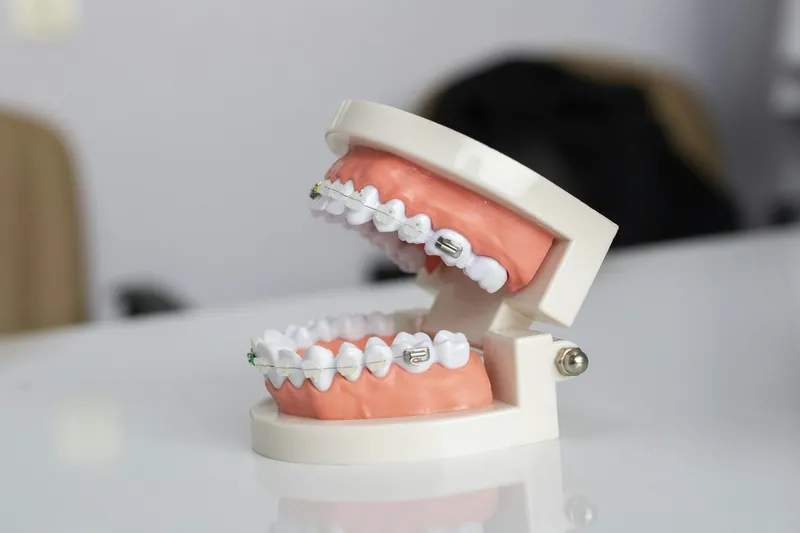Self-ligating braces in Dubai: how clip brackets work and what the evidence says — Manhal Medical Center, Dubai