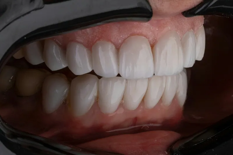 تجميل الابتسامة في دبي — مركز منهل الطبي، دبي