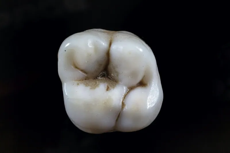 Smoking after tooth extraction — Manhal Medical Center, Dubai