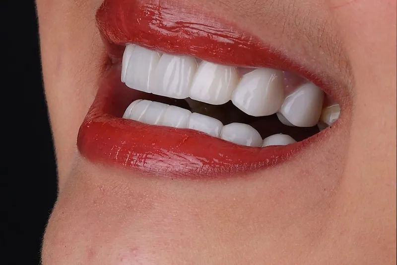 درجات تبييض الأسنان — مركز منهل الطبي، دبي