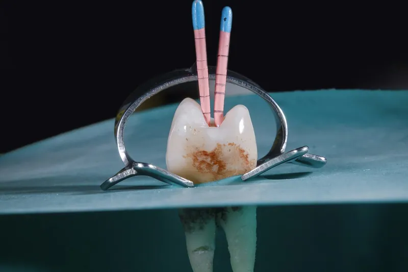 Tooth pain after a root canal — Manhal Medical Center, Dubai
