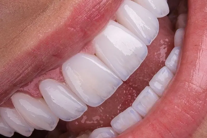 الألم والأكل بعد الفينير — مركز منهل الطبي، دبي