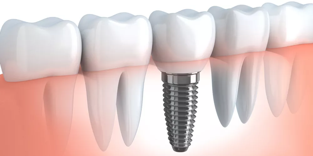 Dental Implant Procedure