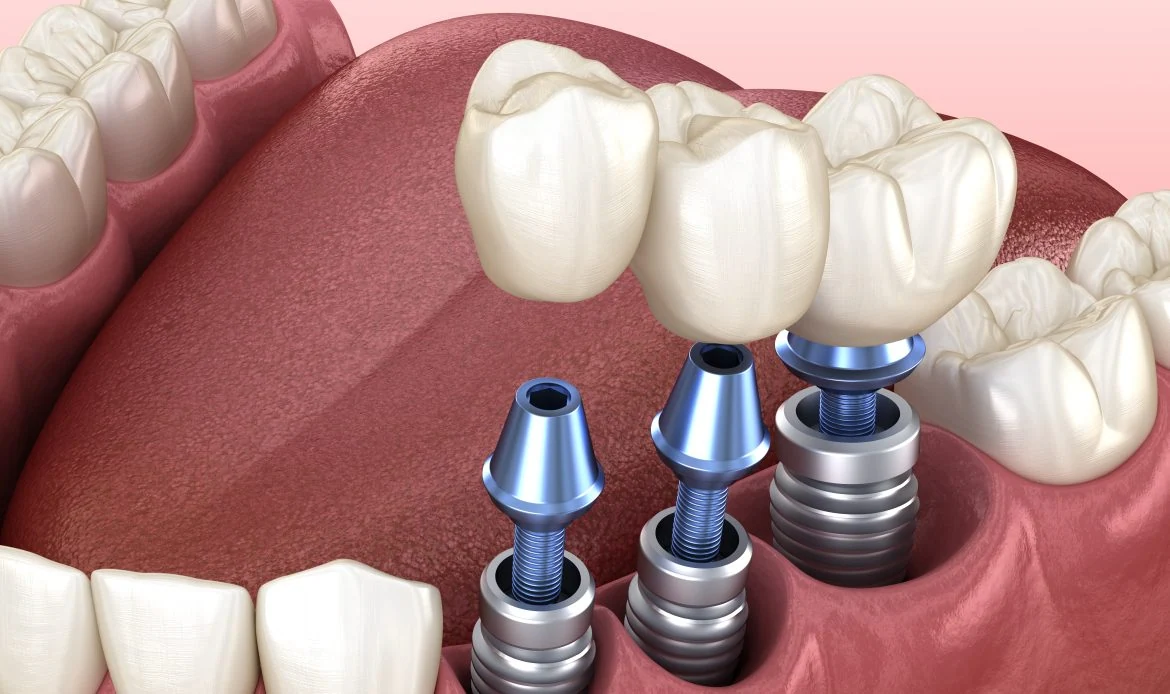 Dental Implants